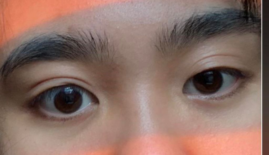 Why Do Asians Have Asymmetrical Eyes?